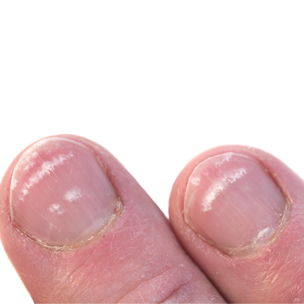Nail Care: Cracking the Code of Vitamin B12 Deficiency - StyleSpeak